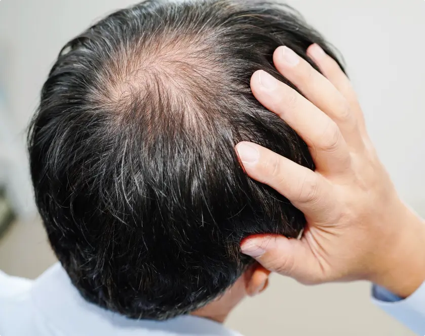 Managing Alopecia Areata or general hair loss.