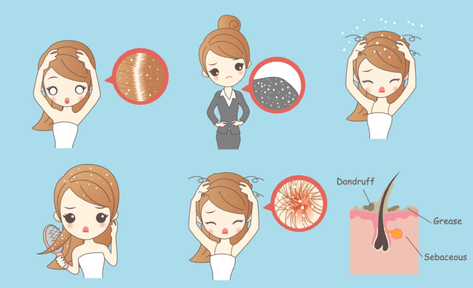 Consequences of dandruff