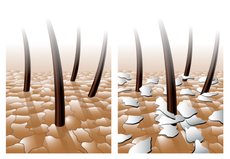 Fungus malassezia is a cause of dandruff