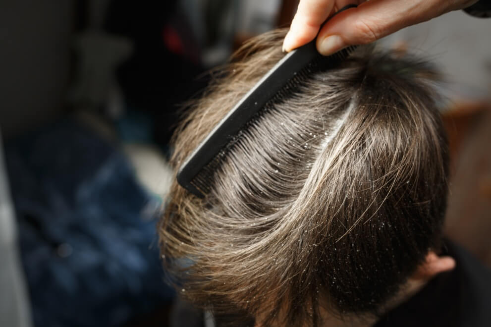 Young patient with dandruff