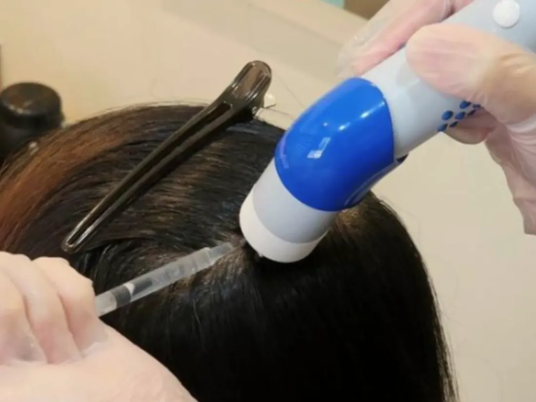 Non-invasive dermoelectroporation therapy for deeper absorption of hair growth solutions