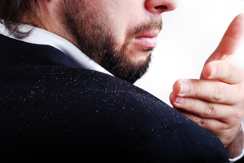 Dandruff: Causes and Treatments