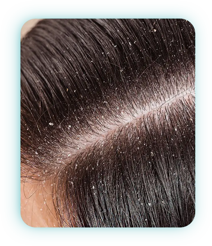 Individuals with a dry, flaky, or itchy scalp