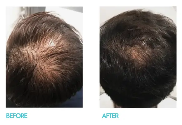 Tried and tested svenson's success storied, male 48, with 6 months of treatment